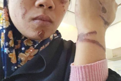 Kisah Devi, PMI Asal Sumbawa yang Diduga Dianiaya oleh Majikan di Libya, Kirim Foto Luka Bakar ke Ayahnya