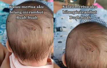 Tangkap layar video rambut menggumpal di kepala anak yang disebut sawan bantal.