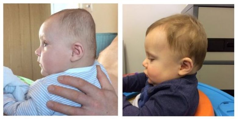 Bentuk kepala bayi sebelum dan setelah terapi menggunakan helm