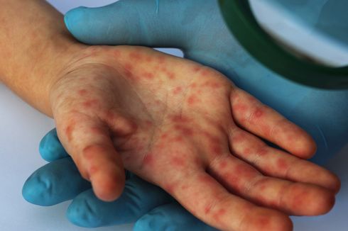 Sering Menyerang Anak, Apakah Orang Dewasa Bisa Alami Flu Singapura?