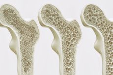 20 Oktober 1996: Hari Osteoporosis Sedunia Pertama Kali Diperingati