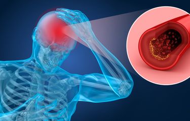 Cara Mengatasi Stroke Ringan Halaman all - Kompas.com