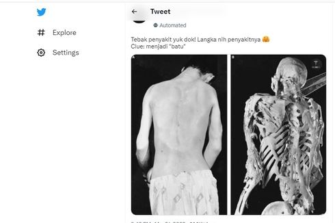 Mengenal Fibrodysplasia Ossificans Progressiva, Penyakit Tulang Langka karena Kelainan Genetik