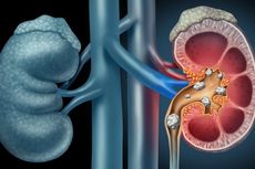 Mengenal Penyakit Batu Ginjal: Penyebab, Gejala, dan Cara Mengobatinya