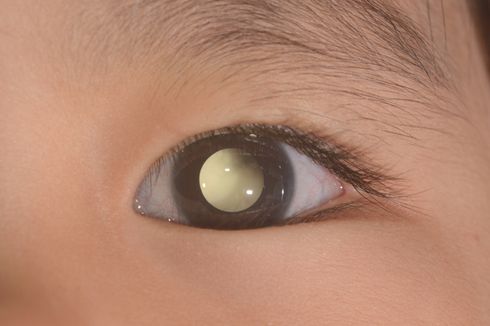 Dosen UMY: Retinoblastoma, Kanker Mata Terbanyak pada Anak