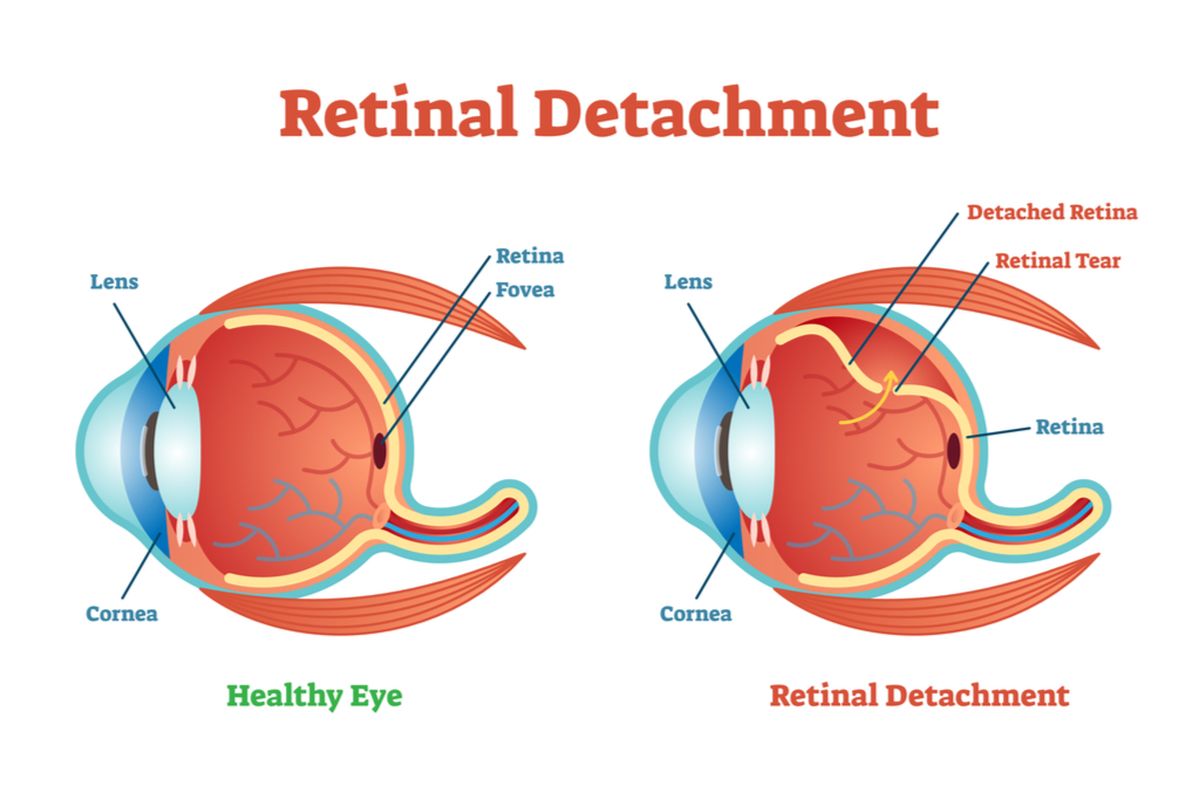 ilustrasi ablasi retina