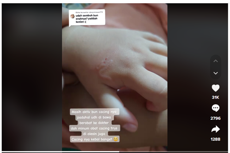 Tangkapan layar unggahan video memperlihatkan terdapat cacing di dalam bagian kulit tangan