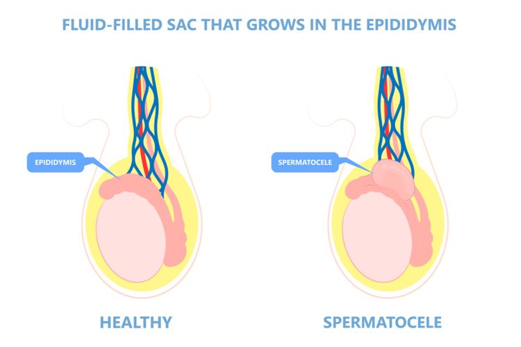 Ilustrasi spermatokel