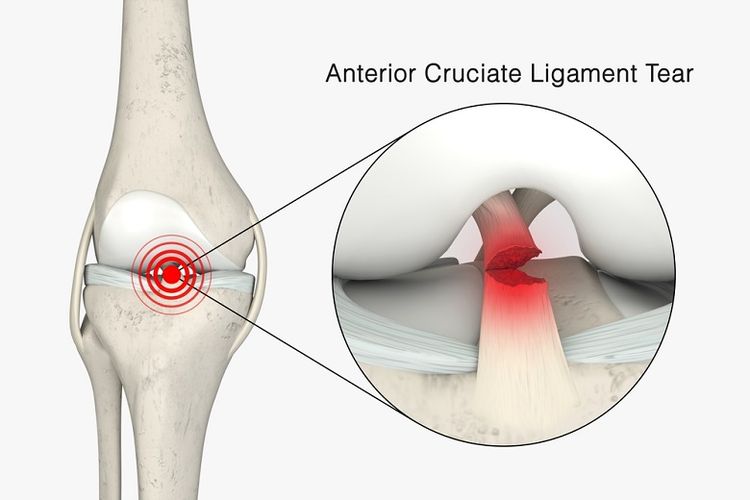 Ilustrasi cedera anterior cruciate ligament (ACL).