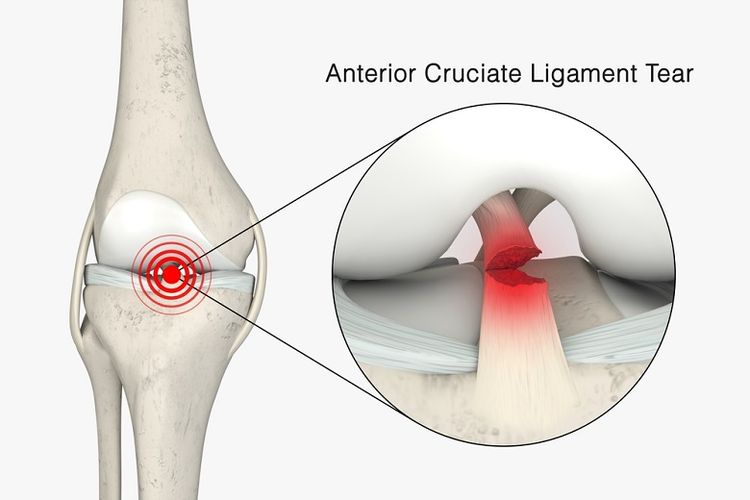 Kerap Dialami Saat Berolahraga Ini Penyebab Dan Cara Penanganan Acl Yang Tepat 9984