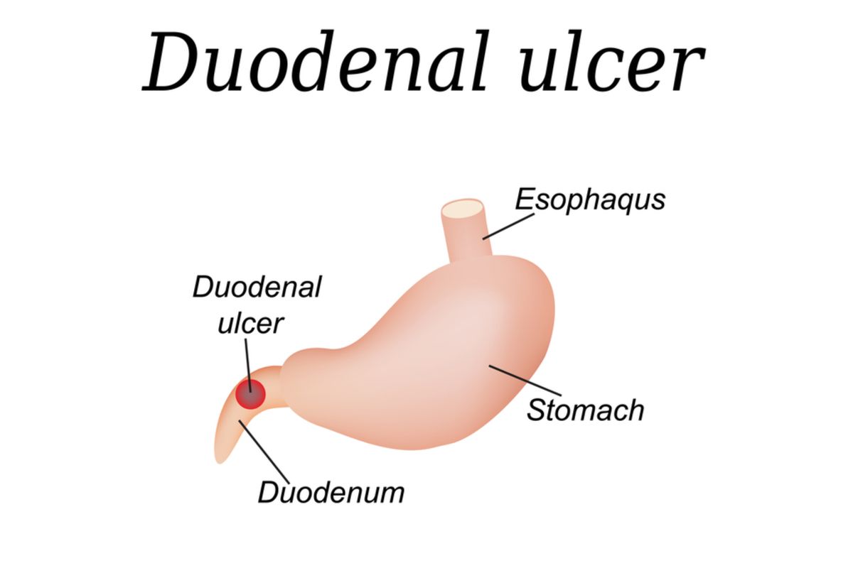 Ilustrasi ulkus duodenum