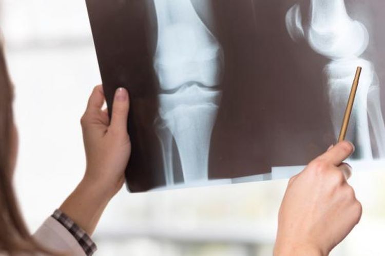 Ilustrasi hasil rontgen orang yang terkena osteoporosis. Osteoporosis merupakan salah satu penyakit penyebab kerusakan tulang. 