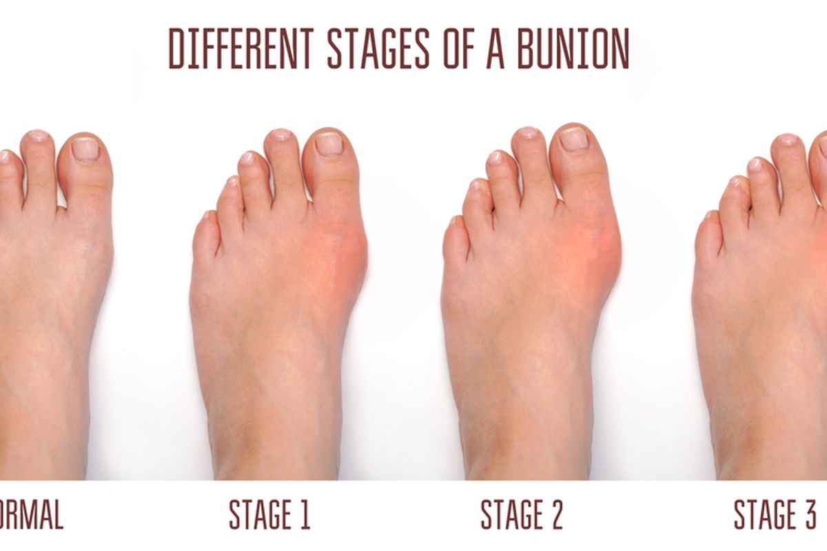 Ilustrasi Bunion