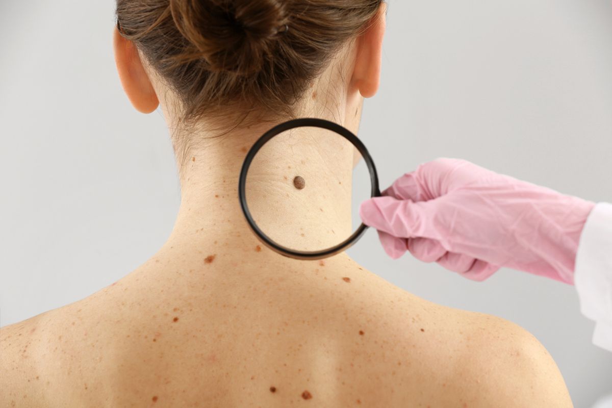 Ilustrasi kanker kulit melanoma, tahi lalat
