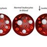 Leukositosis dan Leukimia, Kondisi Jumlah Leukosit di Atas Normal 