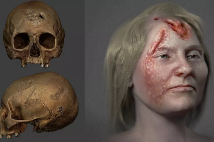 Hasil rekonstruksi wajah wanita yang terkena sifilis pada 500 tahun lalu. Sifilis, penyakit menular seksual ini telah merusak wajah wanita Islandia itu dengan sangat parah