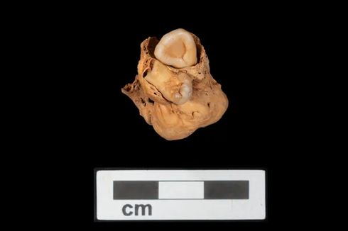Arkeolog Temukan Tumor Langka Berisi Gigi pada Mumi Perempuan Mesir Berusia 3.000 Tahun