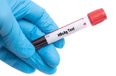Kenali Arti HBsAg Positif pada Pemeriksaan Hepatitis B