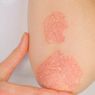 Punya Gejala Mirip, Apa Beda Psoriasis dan Kurap?