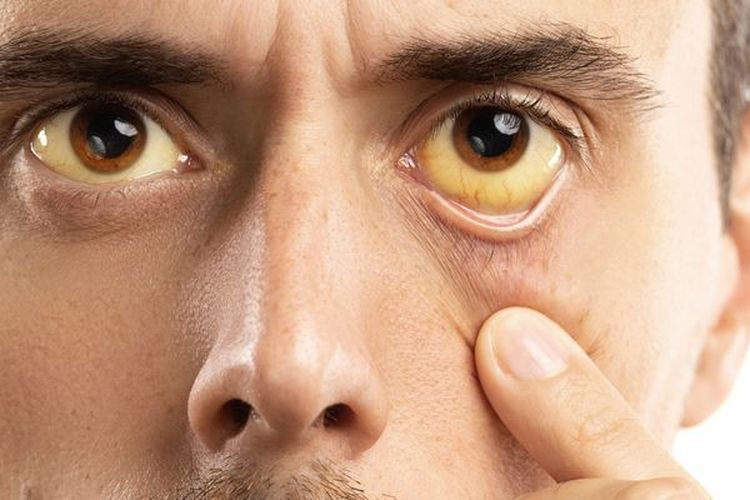 Penyebab dan Cara Mengatasi Mata Berwarna Kuning
