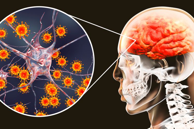 Ilustrasi radang otak atau ensefalitis. 