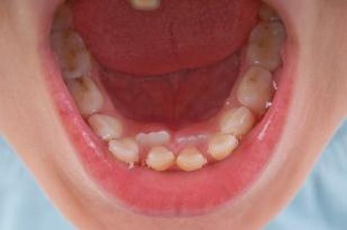Mencabut Gigi Anak yang Berjejal 