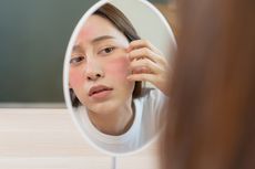 Sederet Efek Samping Retinol pada Kulit, Picu Jerawat