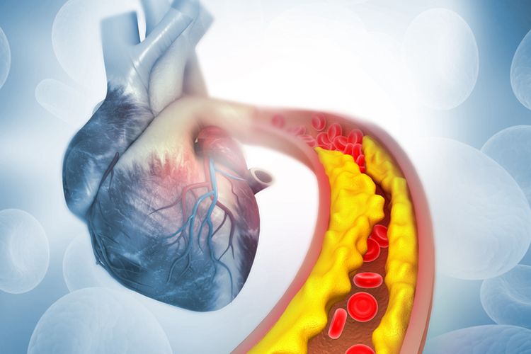 Ilustrasi aterosklerosis. Aterosklerosis terjadi ketika zat lengket yang disebut plak menumpuk di dalam arteri tubuh manusia, seperti jantung, otak, maupun ginjal. 