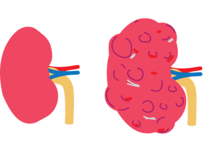 Ilustrasi perbedaan ginjal normal dan ginjal dengan penyakit ginjal polikistik. Penyakit ginjal polikistik dapat mengakibatkan komplikasi kesehatan yang serius bagi orang dewasa dan bayi, seperti aneurisma otak dan gagal ginjal.
