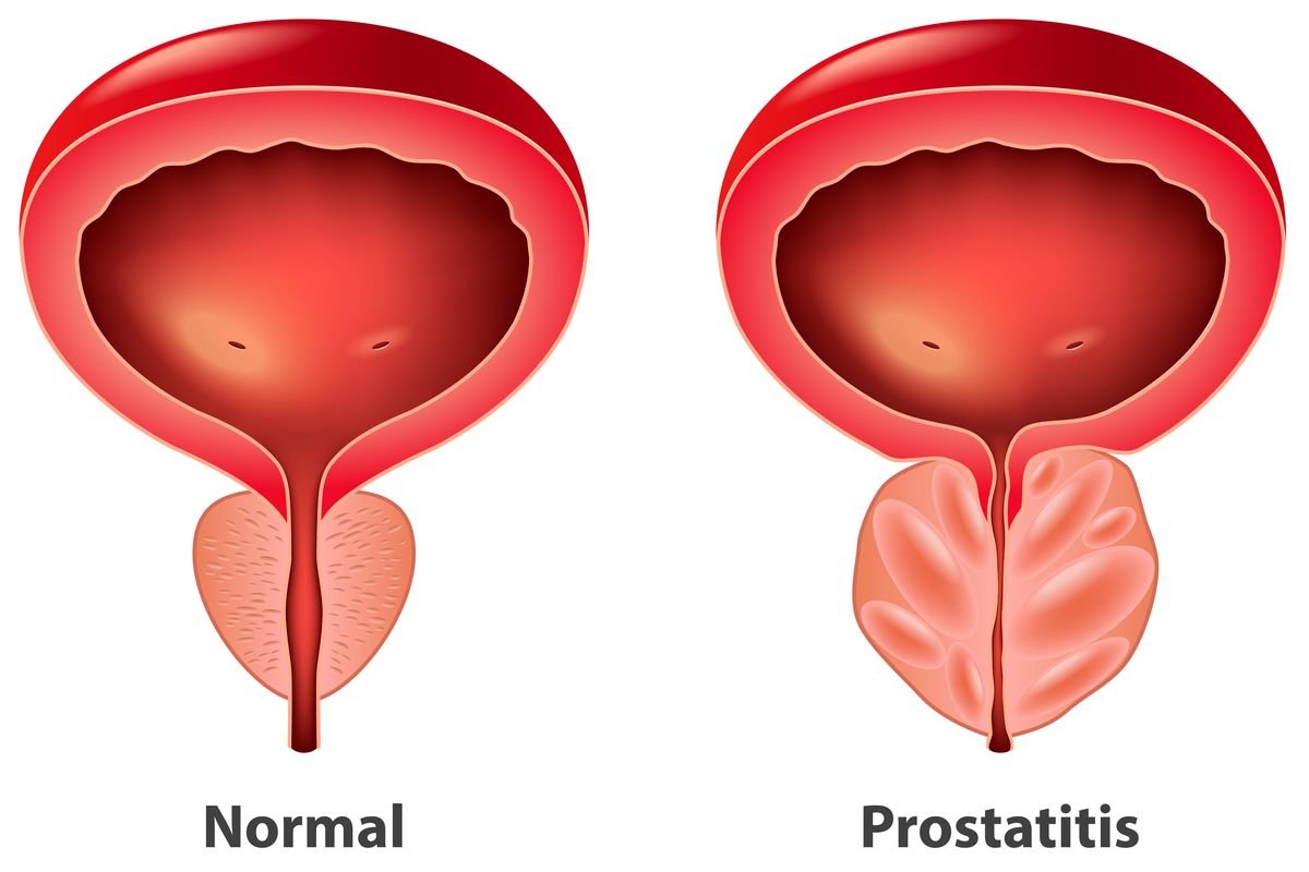 Ilustrasi prostatitis, apa itu prostatitis, gejala prostatitis, penyebab prostatitis