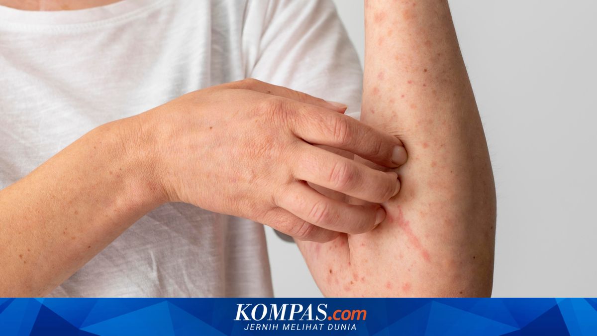 Sudah Pernah Kena Campak Apakah Bisa Terinfeksi Lagi Saat Dewasa? Ini Kata Dokter ~TR

Klik untuk baca: