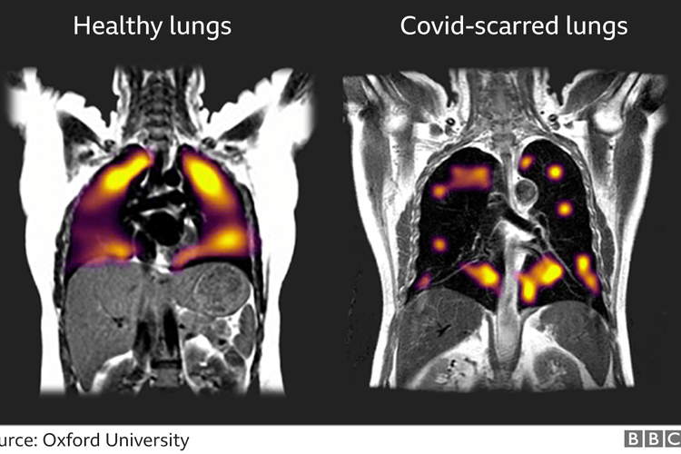 Teknik pemindaian baru menunjukkan kelainan pada paru-paru pasien Covid-19. Pada paru-paru yang terinfeksi, di sebelah kanan, terdapat area gelap yang jauh lebih luas, yang menunjukkan bagian paru-paru yang mengalami kesulitan mengangkut oksigen ke aliran darah.