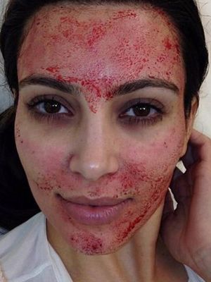 Kim Kardashian dengan facial Vampire