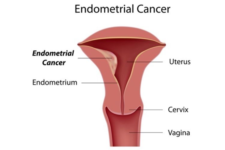 Kanker Endometrium