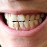 Dua Tumbuhan Ini Bisa Cegah Plak Gigi, Begini Penjelasan Pakar UGM