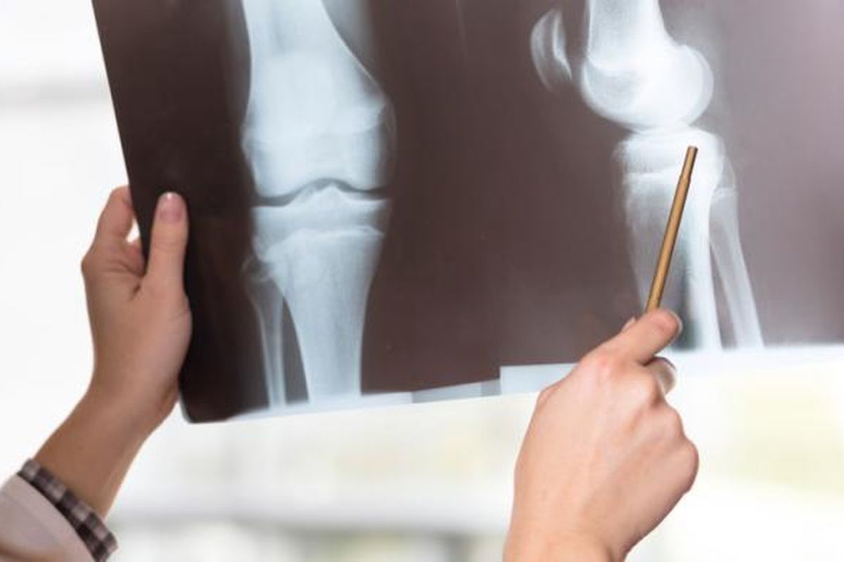 Ilustrasi osteoporosis, kualitas tulang menurun pada lansia. Gejala osteoporosis seringkali tidak terdeteksi. Perempuan rentan mengalami osteoporosis.