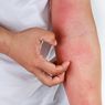 Kenali Apa itu Dermatitis, Jenis, dan Penyebabnya