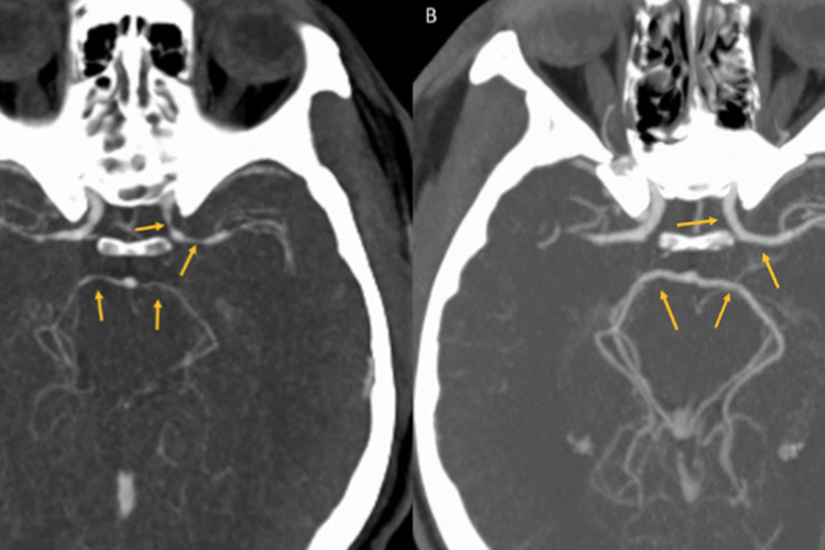Pada Gambar A, CT scan menunjukkan arteri menyempit di otak pria yang makan cabai terpanas di dunia. Pada Gambar B, CT scan menunjukkan bahwa arteri kembali ke ukuran normal setelah lima minggu dilakukan perawatan, termasuk cairan infus dan obat pereda nyeri.