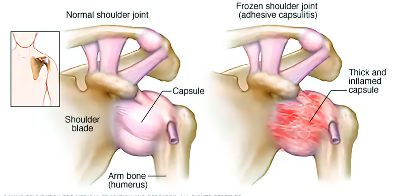 Ilustrasi Frozen shoulder