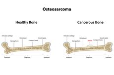 Osteosarkoma