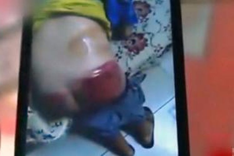 Hu menunjukkan foto kondisi pantat anaknya sesaat setelah dipukul.