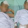 Bocah di Palembang Kencing Bercabang Usai Sunatan Massal Akhirnya Dioperasi