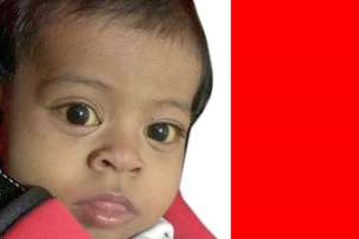 Sabira Husin (12 bulan), lahir di Aceh Utara mengidap penyakit atresia bilier (tidak terbentuknya saluran empedu dengan sempurna) di rawat di RSCM Jakarta butuh bantuan untuk operasi ganti hati. 