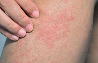 6 Cara Mengatasi Biang Keringat secara Alami dan Pakai Obat