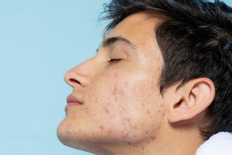 Jerawat stres bisa makin parah jika dibiarkan. Simak beberapa cara mengatasinya, dari skincare yang tepat hingga pola hidup sehat.