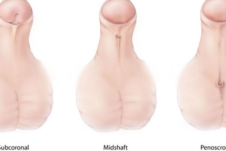 Hipospadia adalah kondisi bawaan lahir di mana pembukaan uretra (saluran kemih) tidak normal. Ada tiga jenis hipospadia berdasarkan pembukaan uretra.