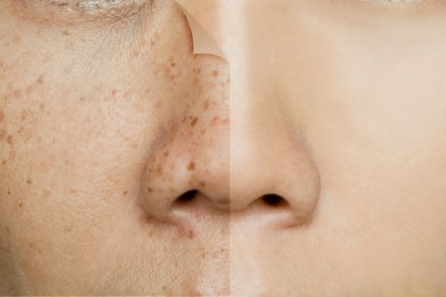 Mengenal Melasma, Flek Hitam di Wajah yang Ganggu Penampilan