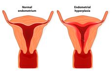 Hiperplasia Endometrium