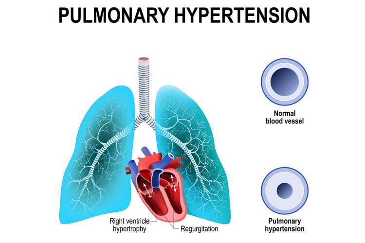 Ilustrasi hipertensi pulmonal