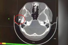 Seorang Pria Sering Sakit Kepala, Rupanya Ada Peluru di Tengkoraknya Selama 20 Tahun